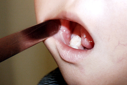 口内炎 病 手足 口 子供の口内炎の原因は？カタル性・ヘルペス性・手足口病などの種類と症状、自宅ケアや予防法【医師監修】